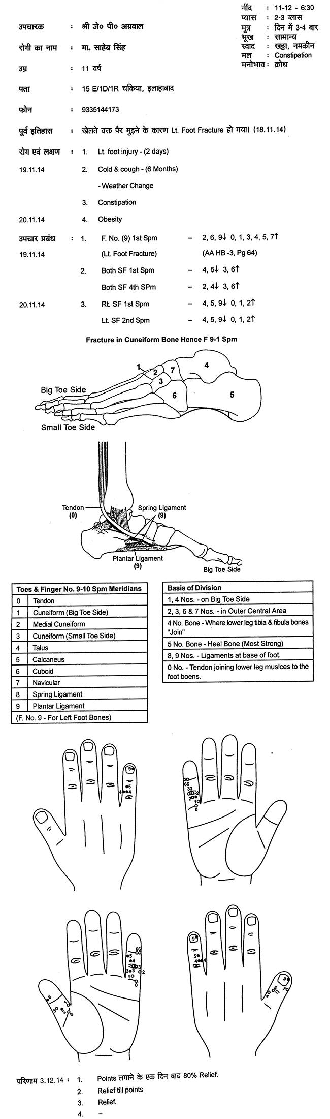 Foot Fracture